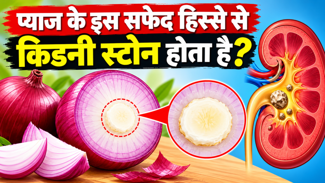 Onion Kidney Stone Myth